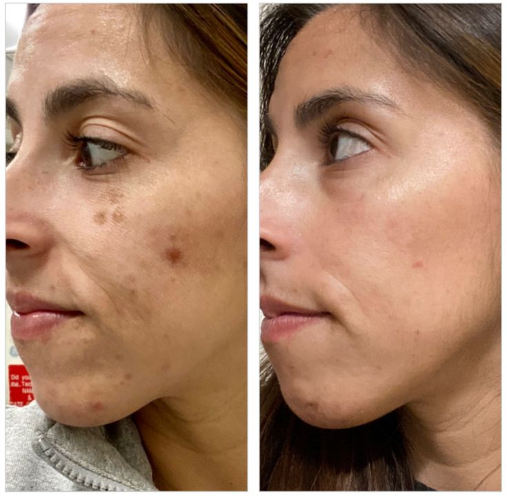 Dark Spot Serum for Sensitive Skin