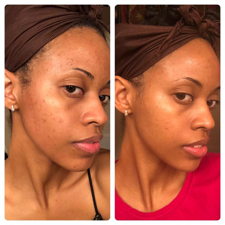 Dark Spot Serum for Sensitive Skin